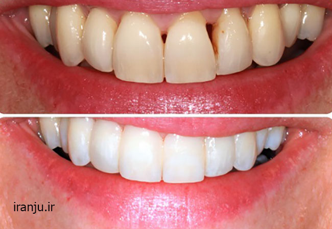 قبل و بعد باندینگ زیبایی دندان