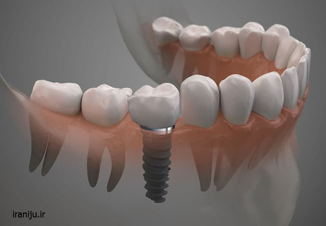 ایمپلنت دندان برای جایگزینی دندان ها