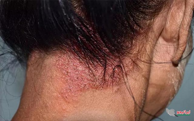 ریزش مو در اثر عفونت پوست سر