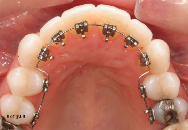 ارتودنسی برای اصلاح ناهنجاری دهان و دندان