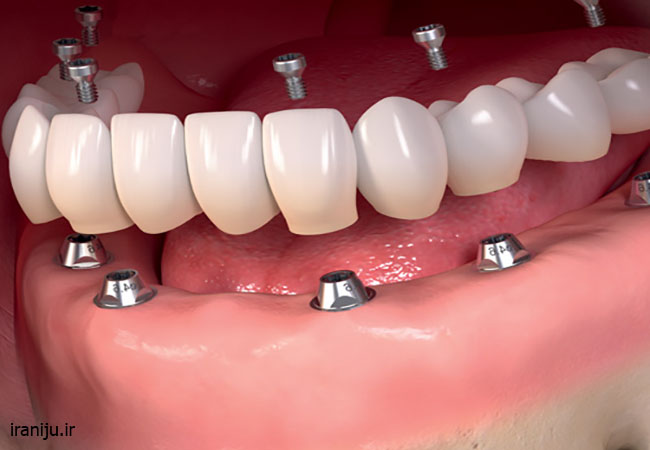 آوردنچر دندان برای جایگزینی دندان ها