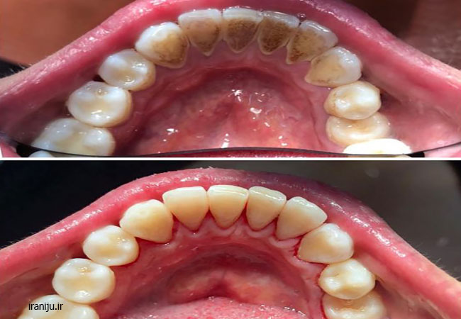 قبل و بعد جرمگیری دندان