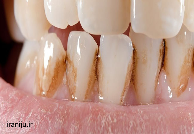 لک قهوه ای روی دندان ها که نیاز به لک گیری دارند
