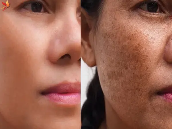 جوانسازی پوست با اسید تراپی