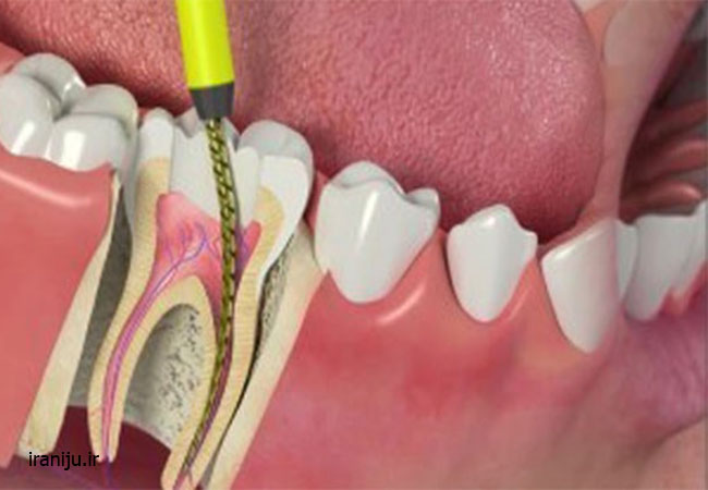 درمان ریشه و عصب کشی دندان